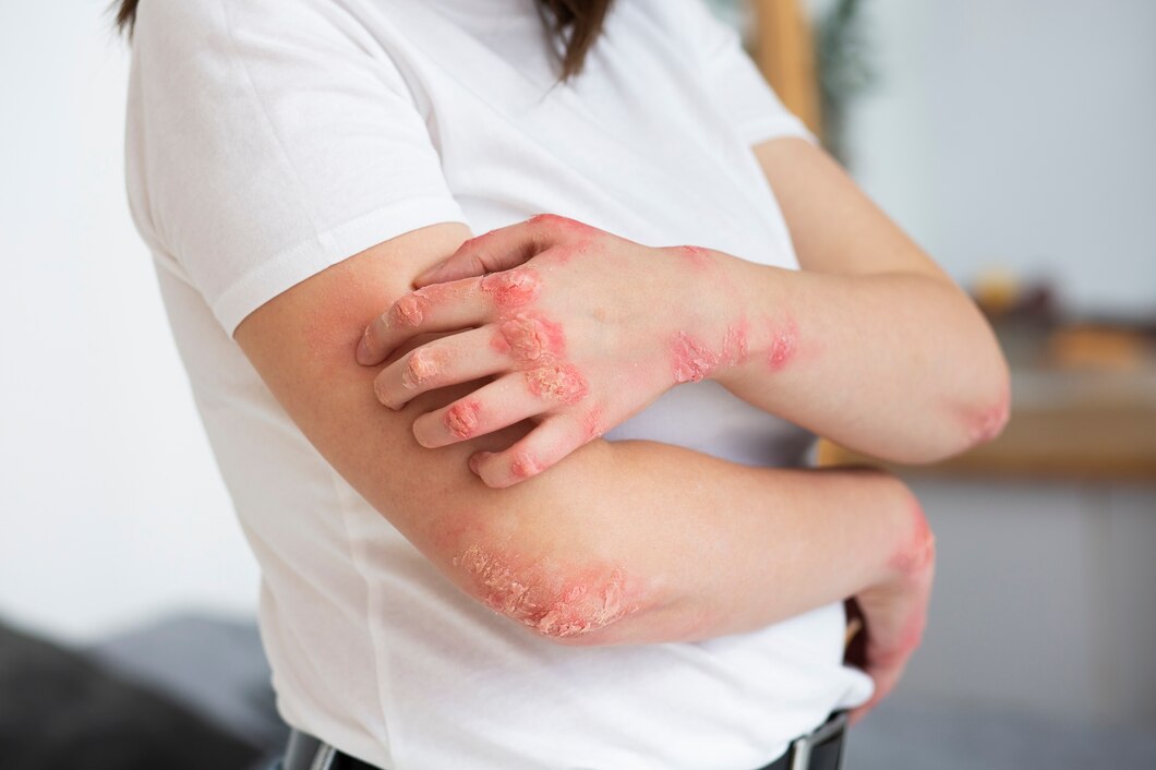 Poradnik dla rodziców – jak rozpoznać i skutecznie leczyć atopowe zapalenie skóry u dzieci